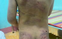 Bình Phước: Bé gái nghi bị bạo hành với nhiều vết thương chi chít trên cơ thể
