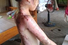 Phú Thọ: Công an “vào cuộc” vụ bé gái bị hàng xóm dội cả ấm nước sôi vào người